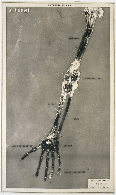 レントゲン｜No.4・腕と手